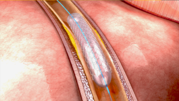 Modeling of Stents