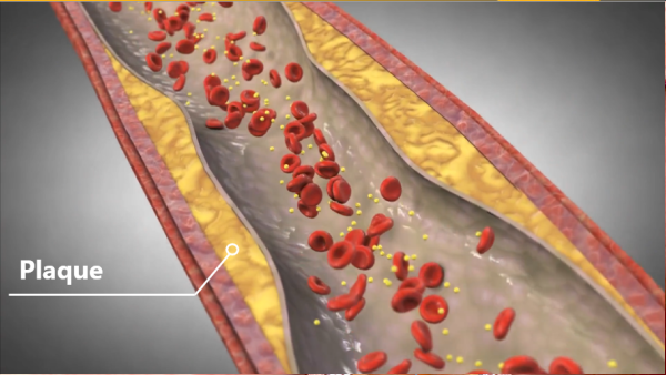 Vessel and Plaque Representation