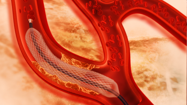 Overview of Stents